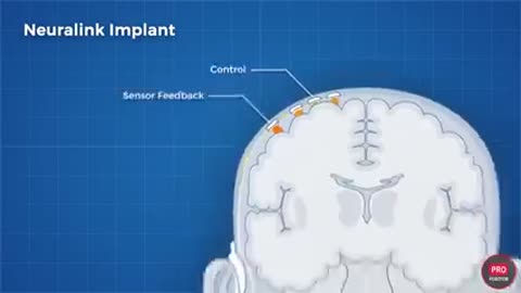 Neuralink__Нейралинк_Илона_Маска_как_работает_критика_новости_2021