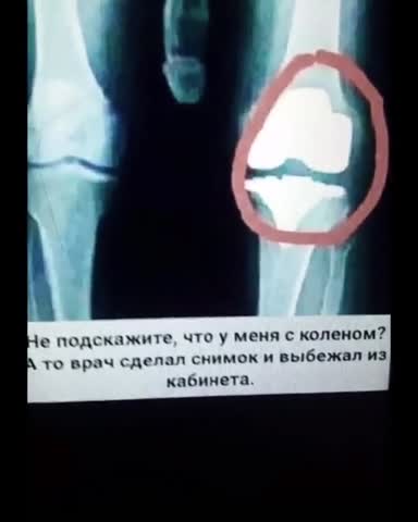 Что с коленной чашечкой